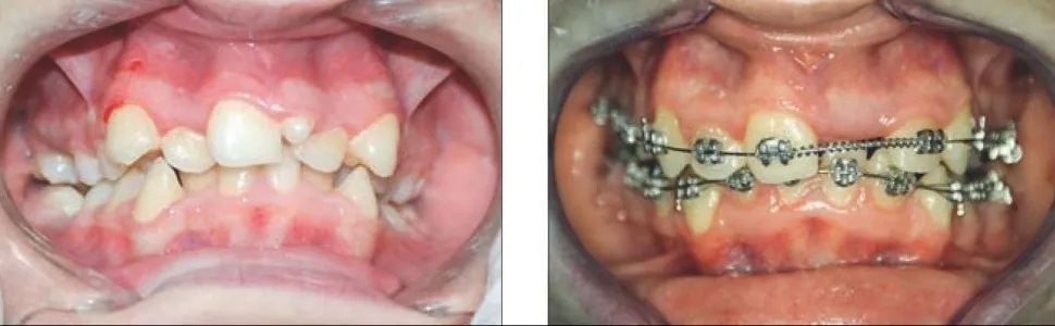 anomalie zębowe hipodoncja hiperdoncja