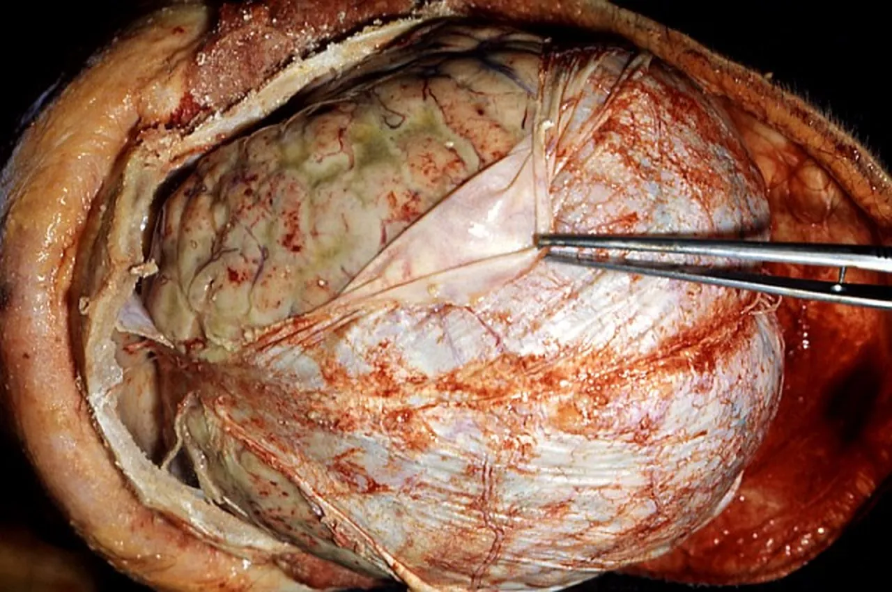 Objawy zapalenia opon mózgowych u dorosłych