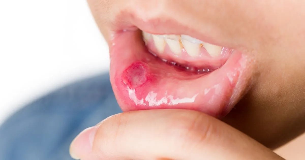Afta w jamie ustnej