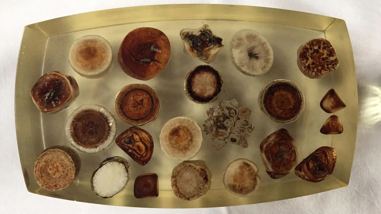 Gallensteine verschiedene Formen