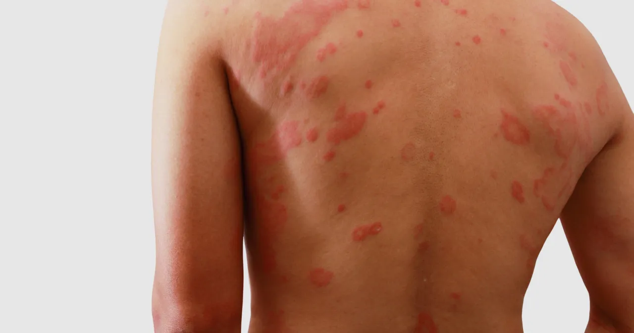 Reakcja alergiczna na antybiotyk