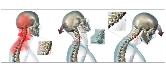mechanizm urazu smagnięcia biczem kręgosłupa szyjnego