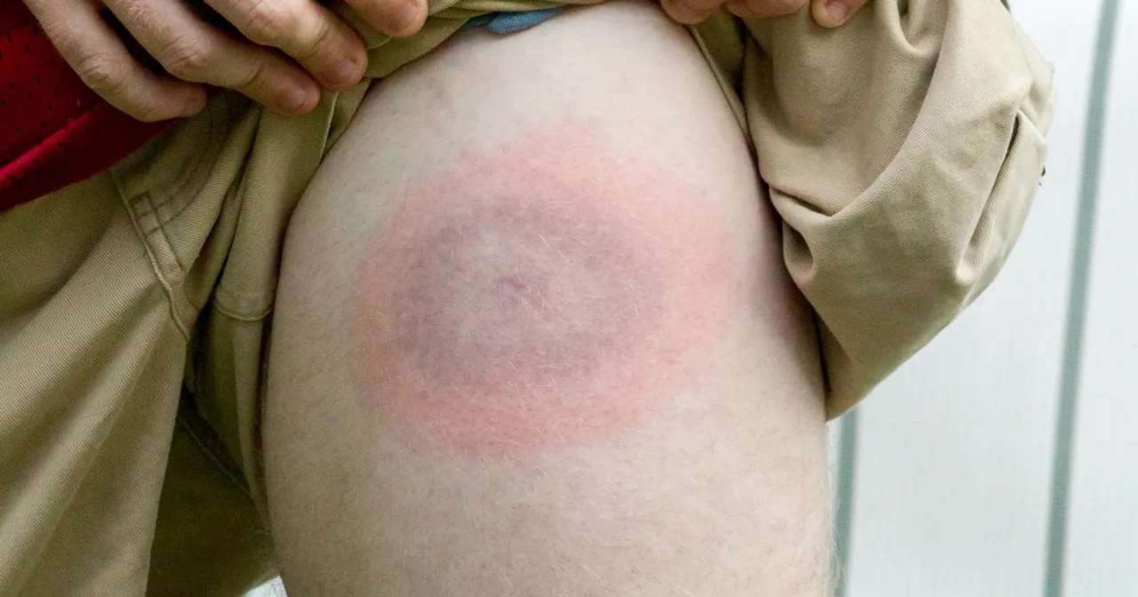 rumień wędrujący etapy