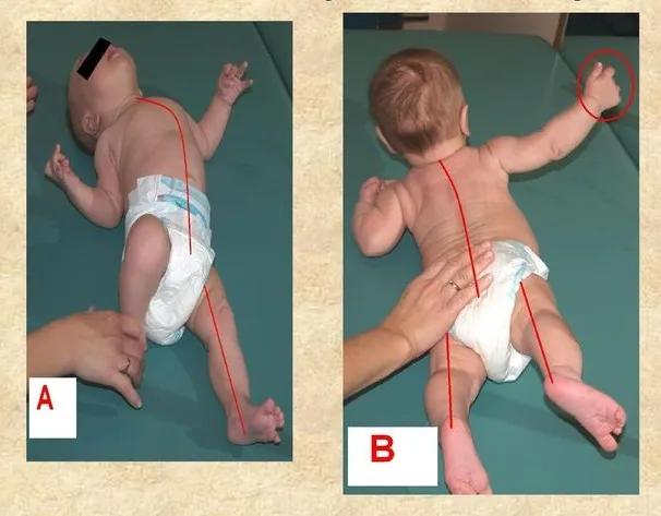 niemowlę z wzmożonym napięciem mięśniowym prężące się