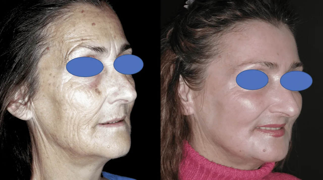 Zdjęcie Peeling fenolowy ile się goi? Poznaj czas regeneracji skóry