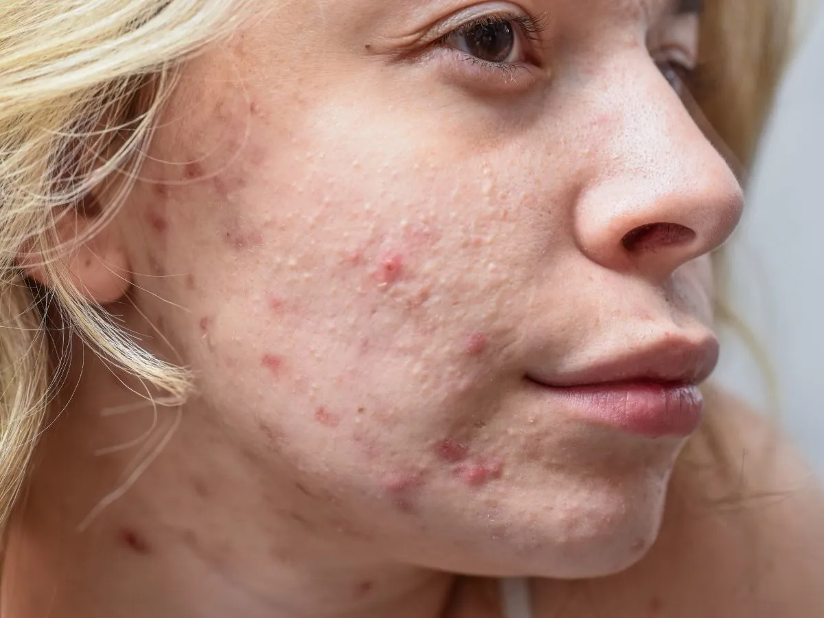 plastry hydrokoloidowe na pryszcze przed i po