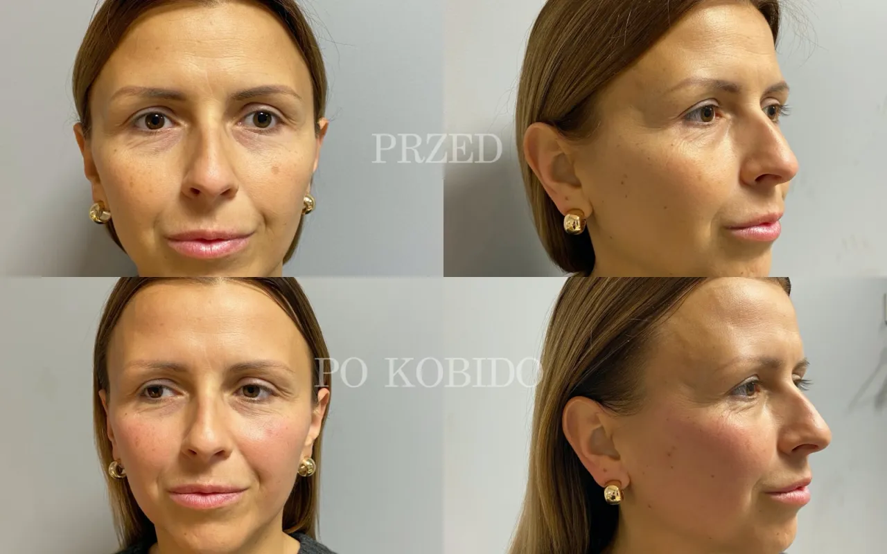 efekty masażu kobido przed i po