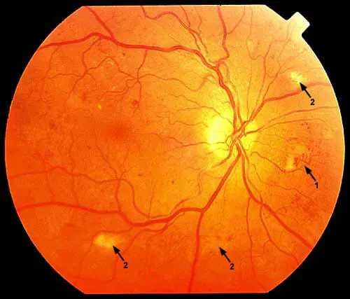retinopatia cukrzycowa obraz dna oka