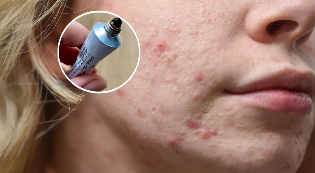 Ile trzymać maść ichtiolową na pryszczu