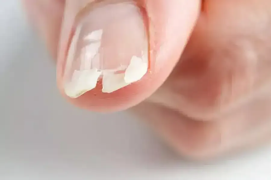 łamliwe paznokcie przyczyny