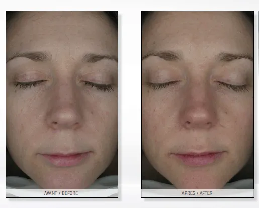 endermologia twarzy przed i po