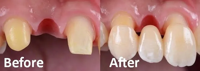 Most protetyczny wygląd przed i po