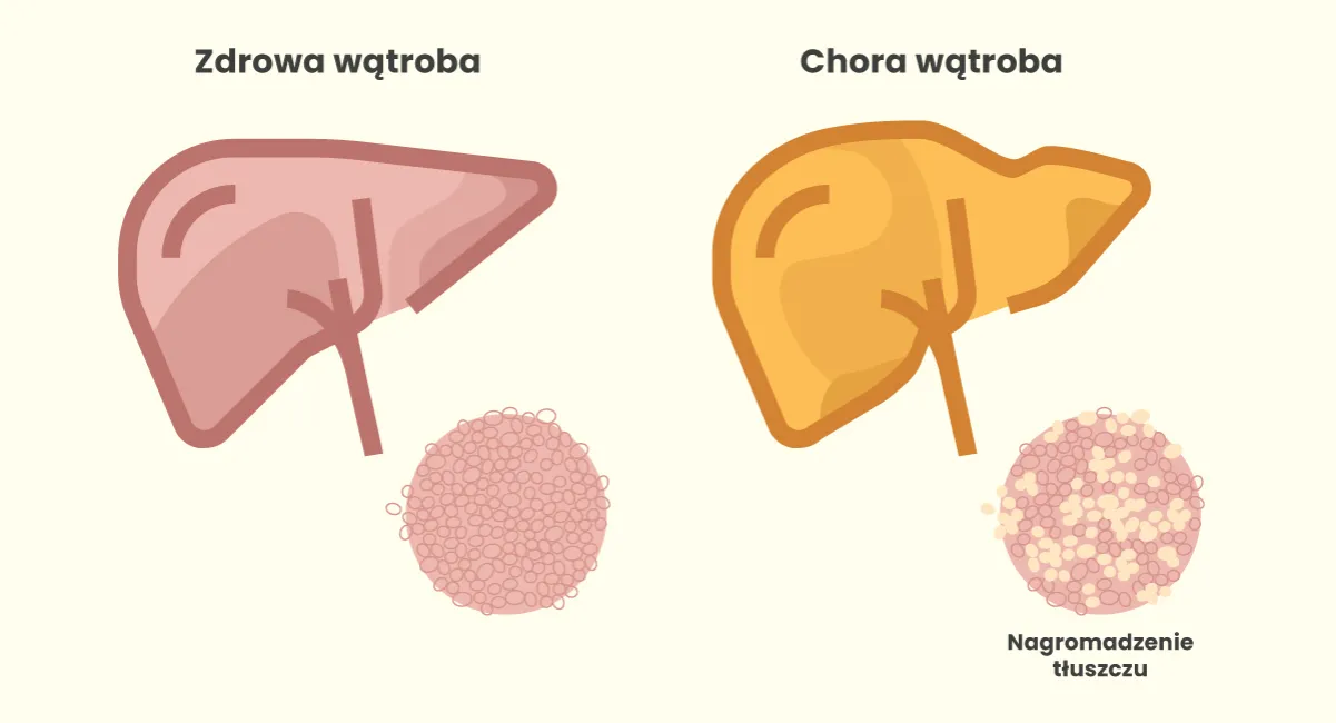 zdrowa wątroba vs stłuszczona wątroba