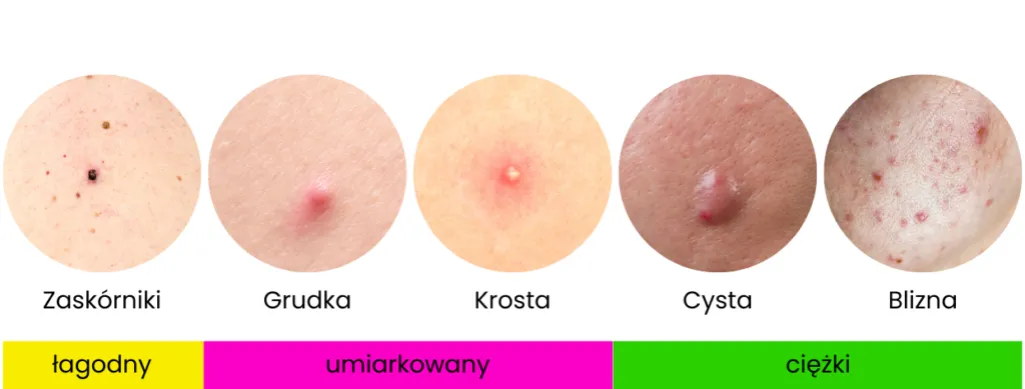 Rodzaje trądziku wymagające wizyty u dermatologa