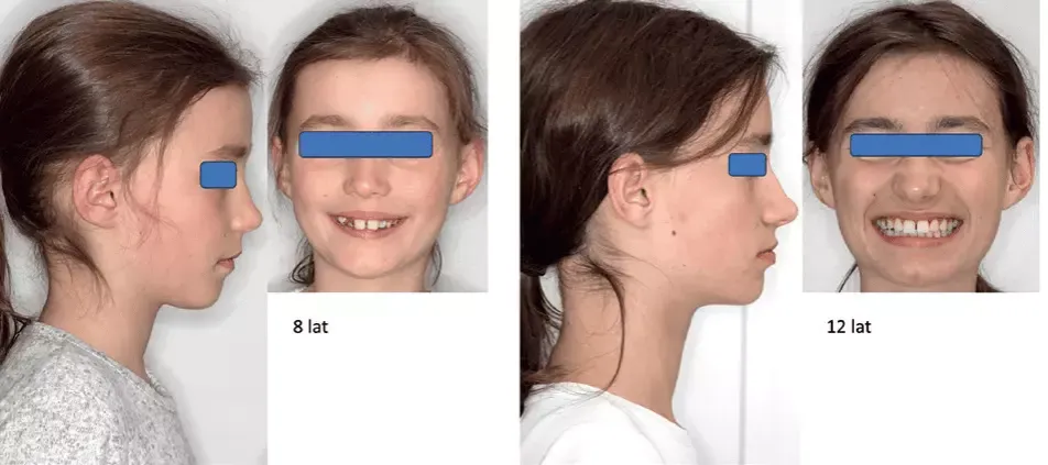 leczenie ortodontyczne dorośli vs dzieci efekty twarzy