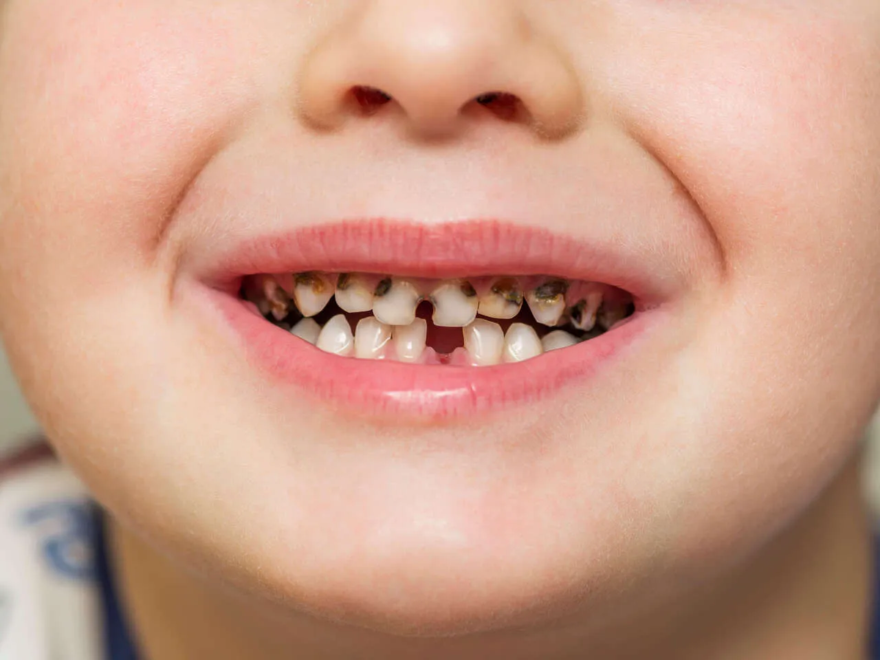 pr&oacute;chnica wczesna faza plama pr&oacute;chnicowa vs ubytek