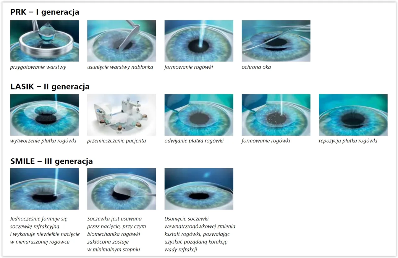 laserowa korekcja wzroku metody SMILE LASIK