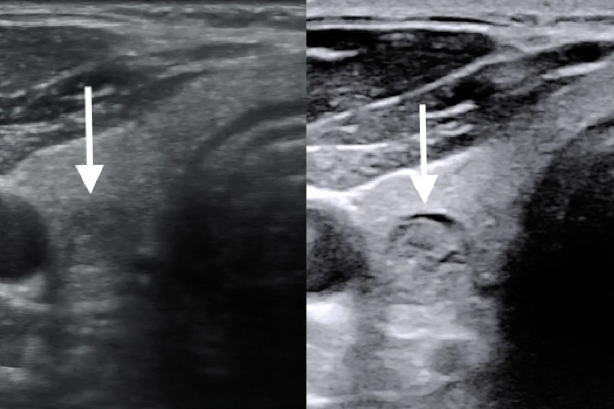USG tarczycy lub schemat guzk&oacute;w tarczycy