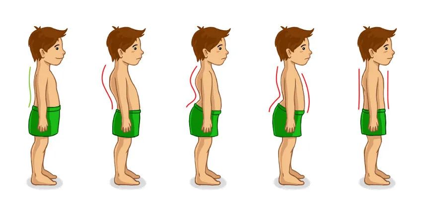 wady postawy u dzieci przykłady
