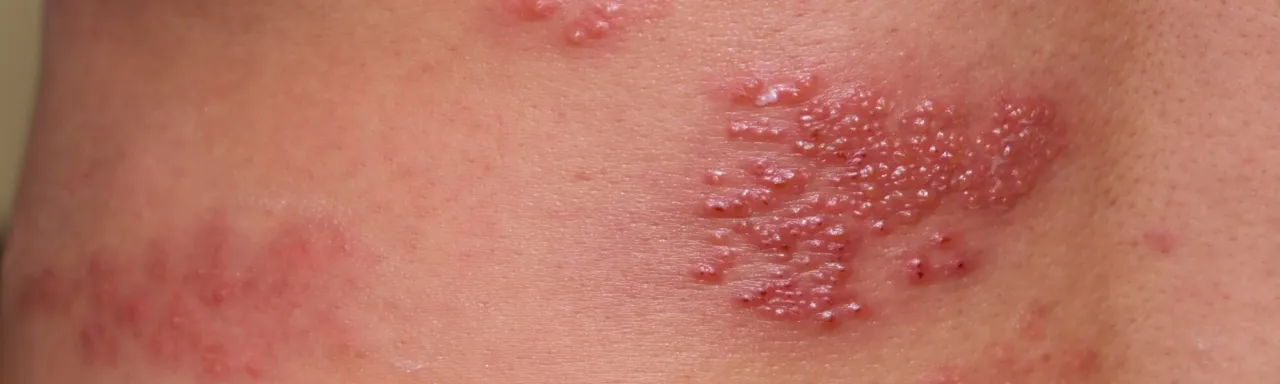 Choroba Duhringa zdjęcia