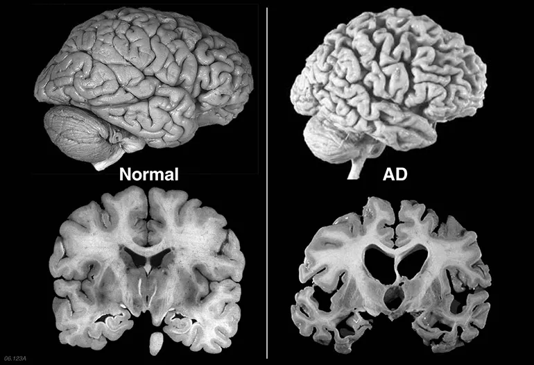 Porównanie zdrowego mózgu i mózgu z chorobą Alzheimera