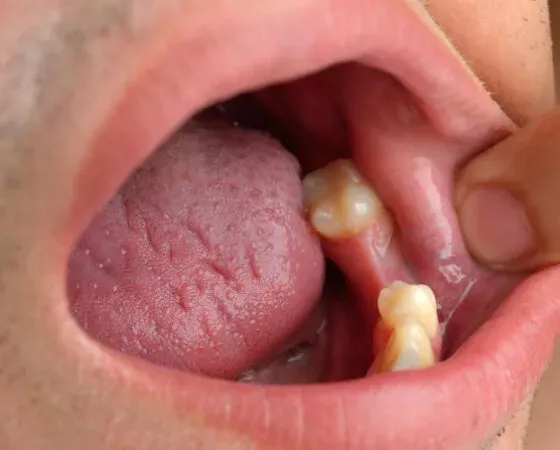 Objawy suchego zębodołu