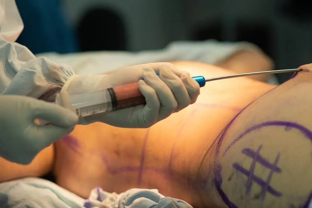 liposukcja jak działa mechanizm zabiegu