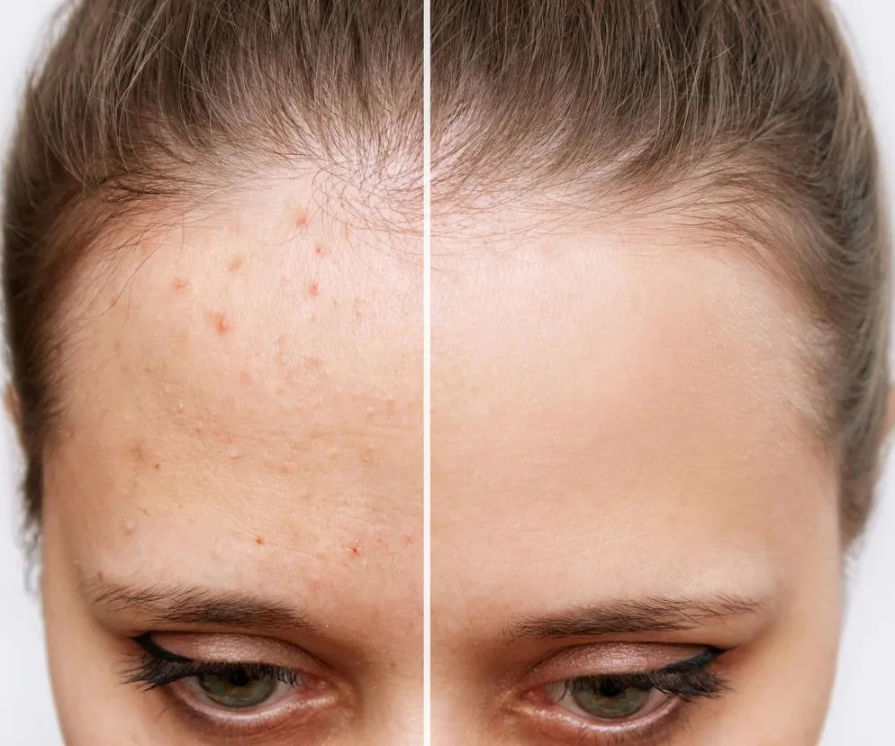 domowe sposoby na pryszcze lód olejek herbaciany