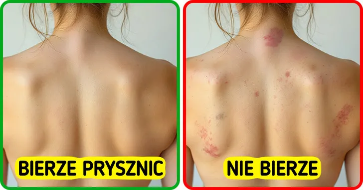 konsekwencje braku higieny sk&oacute;ry