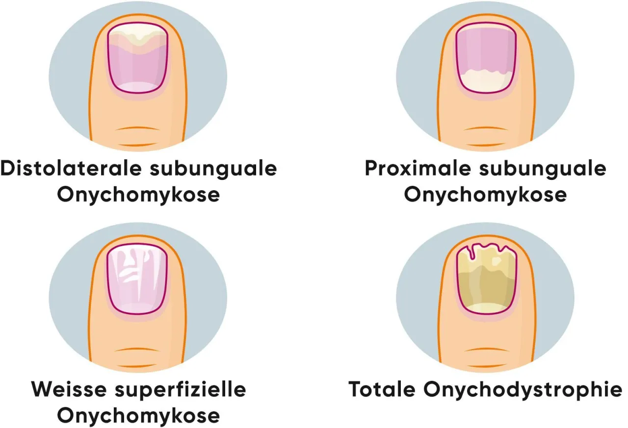 Nagelpilz vs gesunder Nagel