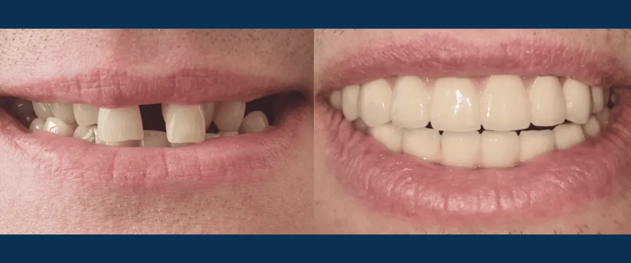 uśmiech przed i po wybielaniu zęb&oacute;w, implant stomatologiczny