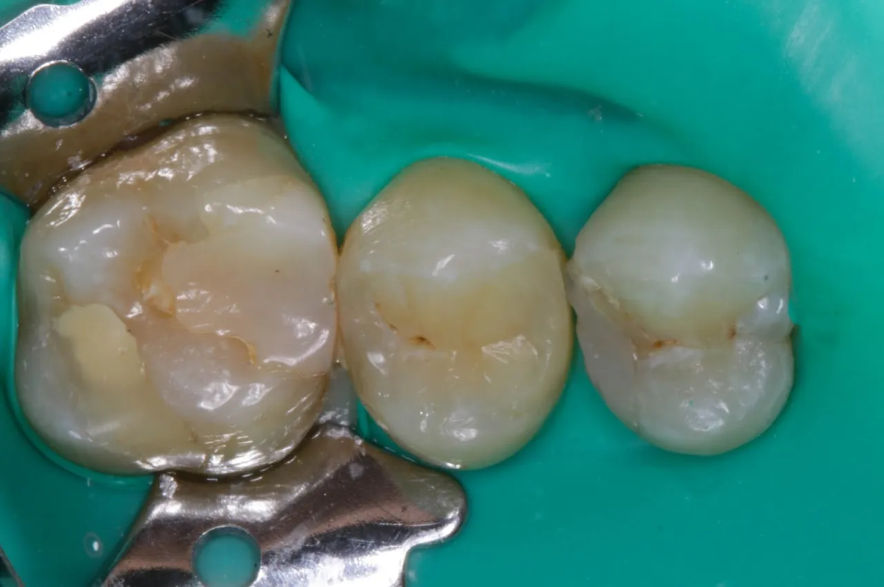 zatruty ząb opatrunek