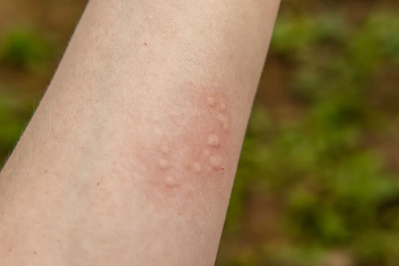 pokrzywka objawy skórne bąble