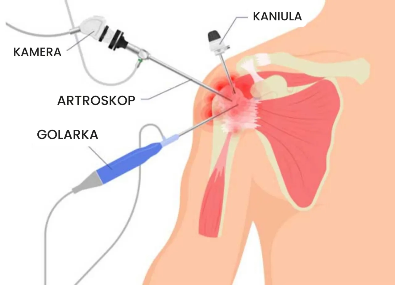 Zdjęcie Artroskopia barku NFZ - terminarz najkrótszych kolejek w Polsce 2025