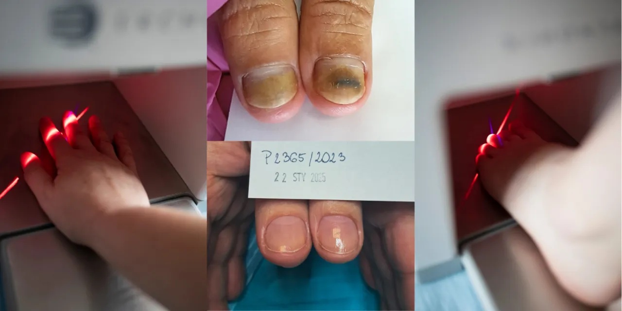 Grzybica paznokci przyczyny objawy