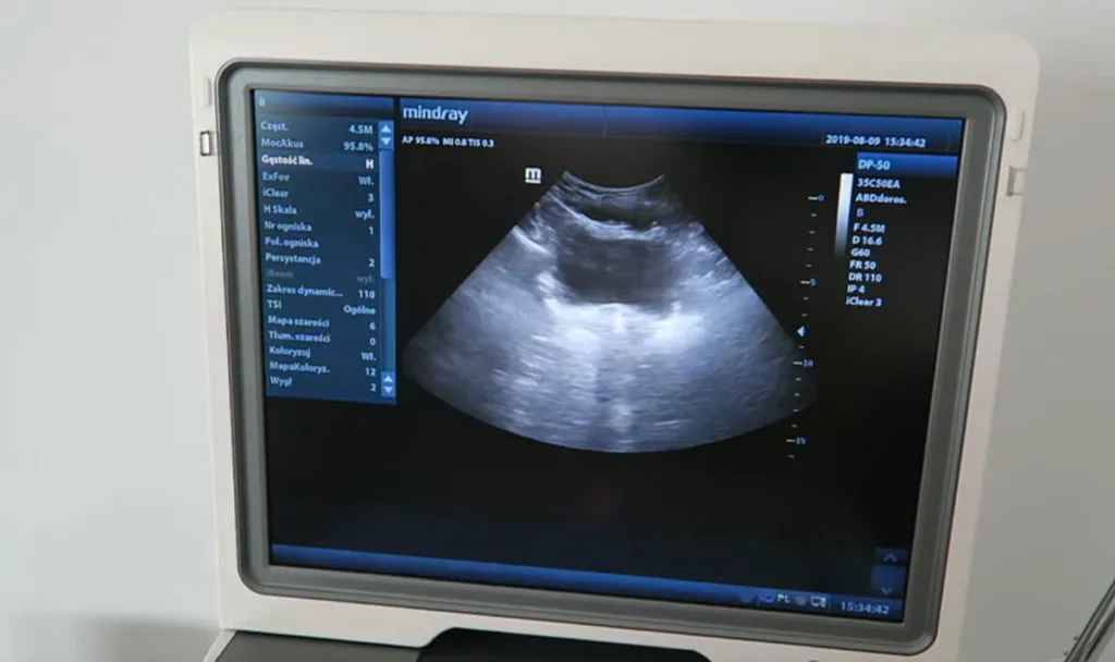 USG mięśni dna miednicy