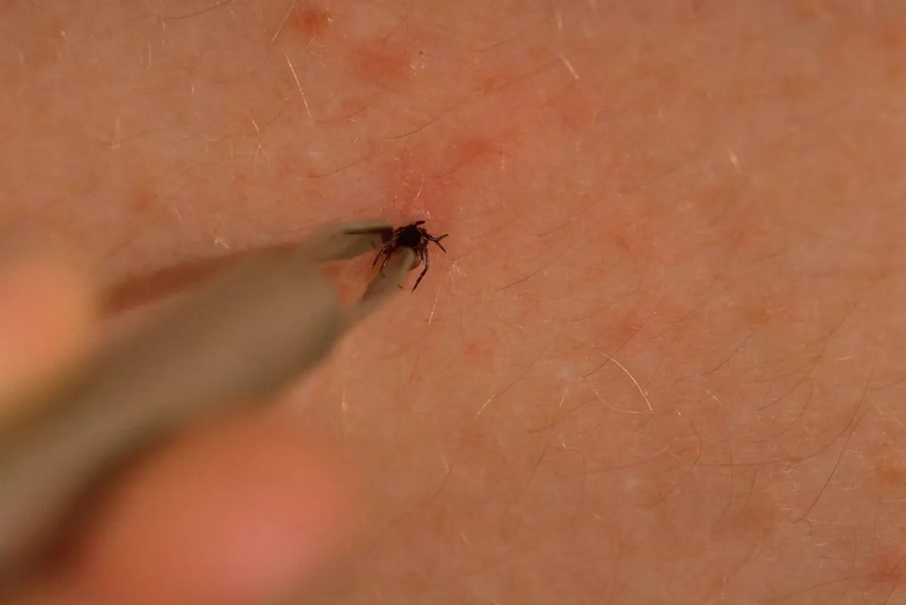 jak usunąć kleszcza pęsetą instrukcja krok po kroku