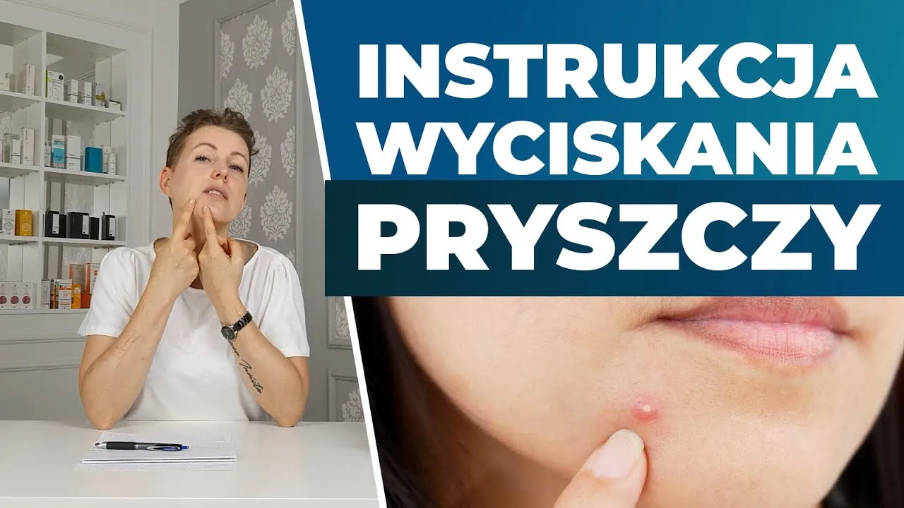Zdjęcie Jak wycisnąć pryszcza bez ryzyka blizn i infekcji - krok po kroku