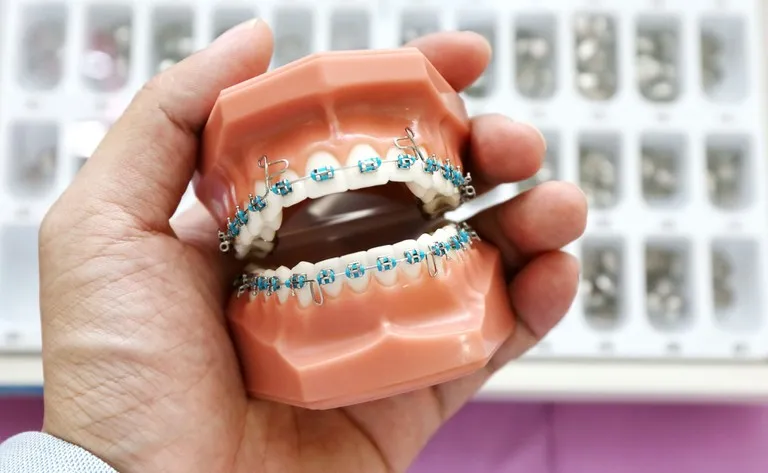 Zdjęcie Ile kosztuje aparat na zęby dla 13-latki? Ceny i opcje, które musisz znać