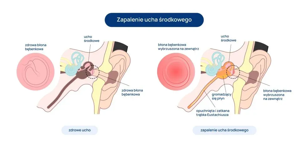 Zdjęcie Najczęstsze objawy zapalenia ucha: jak rozpoznać groźną infekcję?
