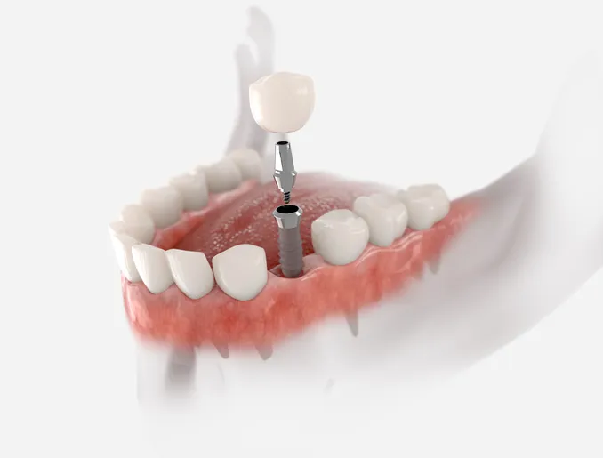 Zdjęcie Ile kosztuje implant zęba? Sprawdź ceny i ukryte wydatki