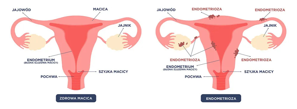 Zdjęcie Jakie leki na endometriozę? Poznaj skuteczne metody łagodzenia bólu