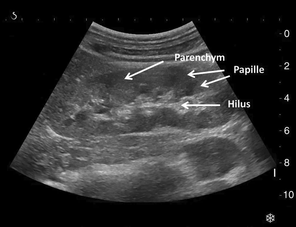 Nieren Ultraschall Bild