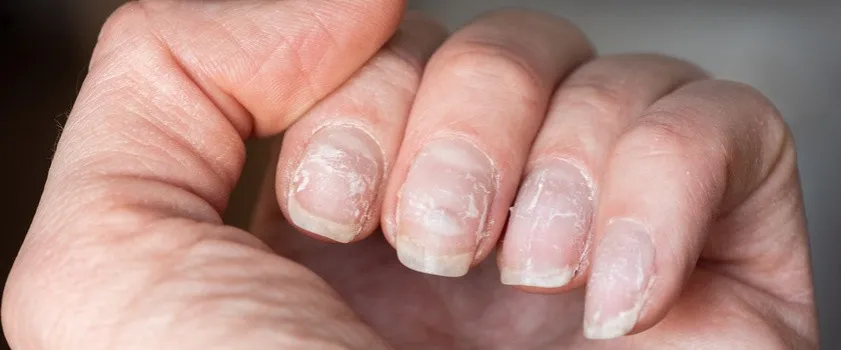 Zdjęcie Jak wyglądają rozdwajające się paznokcie i jak je rozpoznać?