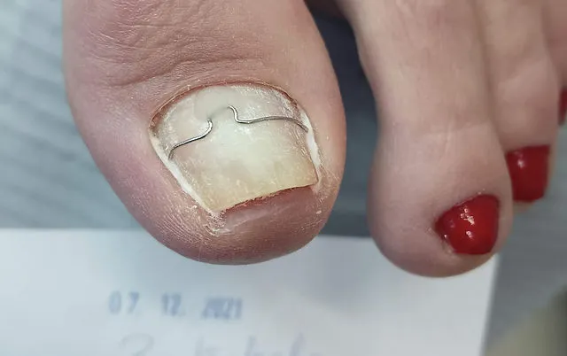 klamry ortonyksyjne na wrastający paznokieć