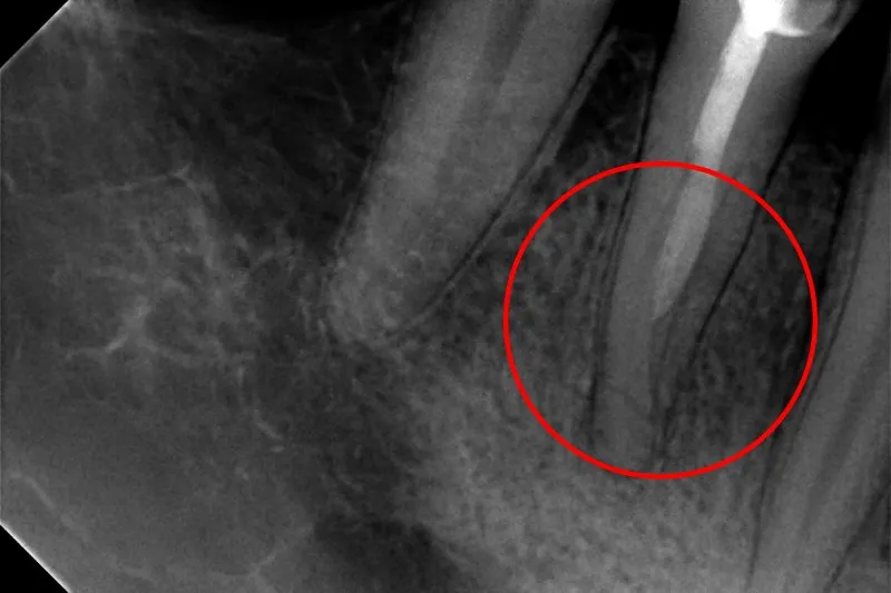 zdjęcie RTG ząb do leczenia kanałowego