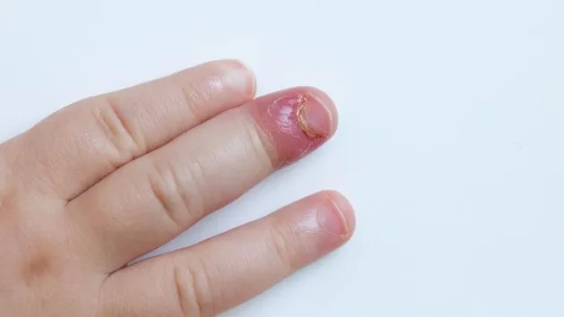 jak zapobiegać zastrzałowi u dzieci