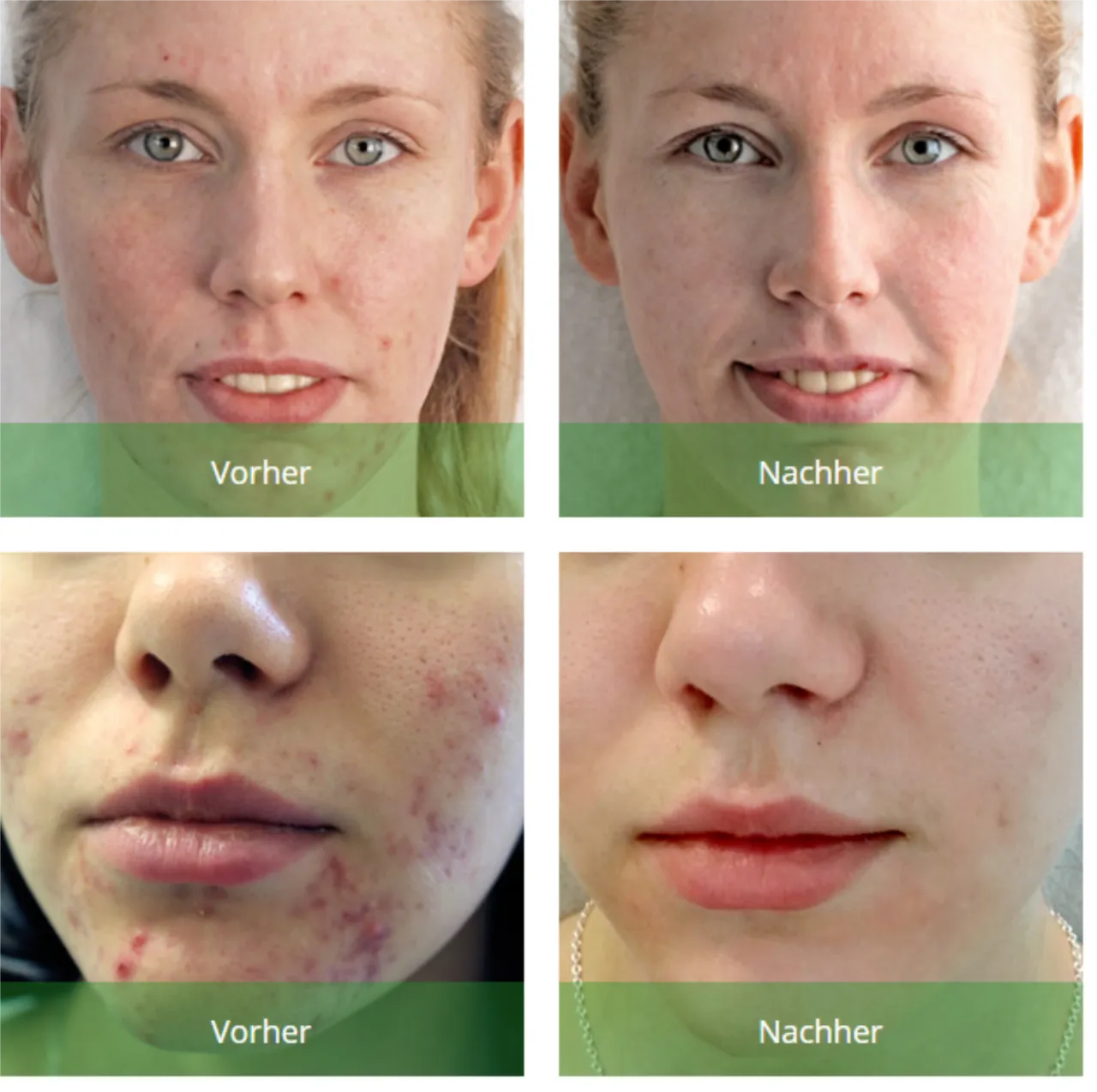 Green Peel Kr&auml;utersch&auml;lkur Vorher Nachher