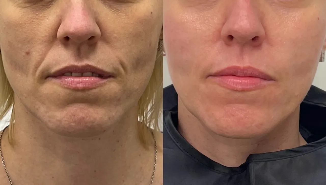 Zabiegi z kwasem hialuronowym przed i po