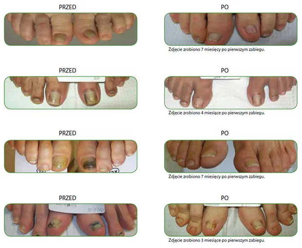 etapy gojenia łożyska paznokcia